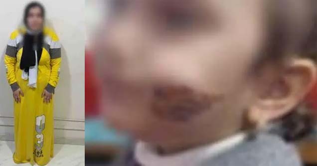 ست الحبايب تشوه وجه طفلتها حرقاً لسبب لا يخطر على بال
